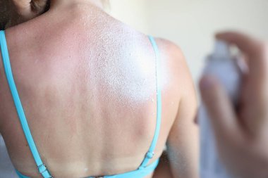 Yanmış cilde bronzlaştırıcı sprey sıkan adam.