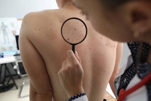 Doctor oncologist with magnifying glass in his hand examines pigmented nevi on patients back in clinic — Stock Photo, Image
