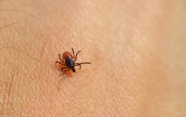 Tik (Ixodes ricinus) insan derisi üzerinde. Parazit hem Lyme Borrelia hem de Tick-Borne Ensefaliti bulaştırır..