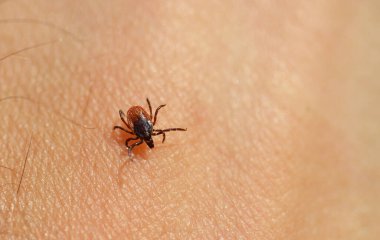 Tick ( Ixodes ricinus ) on human skin. Parasite transmit both Lyme Borrelia and Tick-Borne Encephalitis. clipart