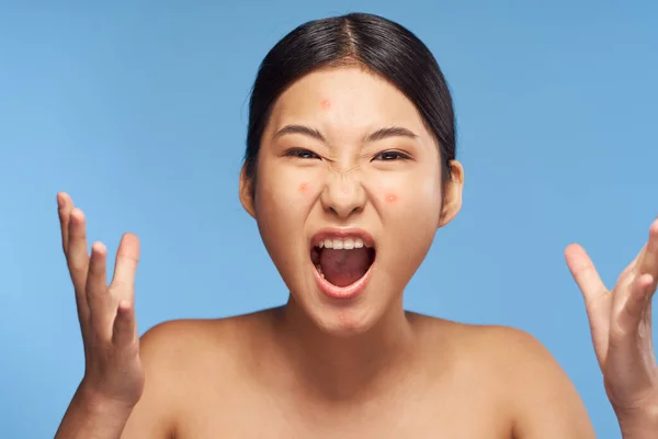 Jovem Bela Mulher Asiática Chateado Sobre Acne Estúdio — Fotografia de Stock