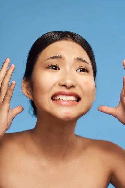 Jeune Belle Femme Asiatique Bouleversée Par Acné Plan Studio — Photo