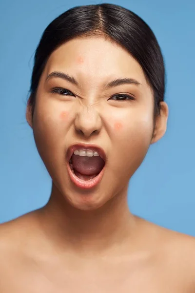 Joven Hermosa Mujer Asiática Molesto Por Acné Captura Estudio — Foto de Stock