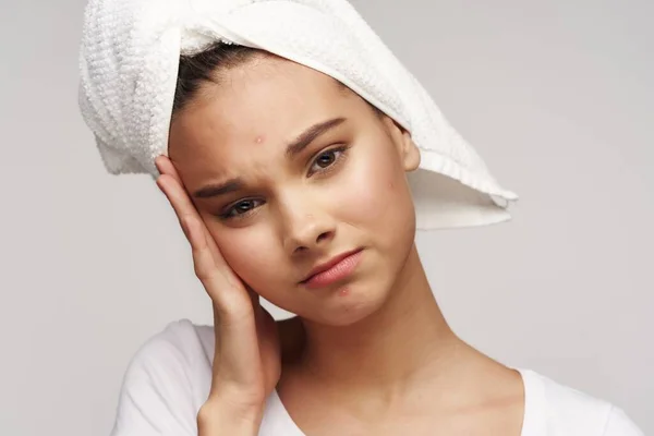 Flicka med en handduk på huvudet akne i ansiktet hälsa — Stockfoto