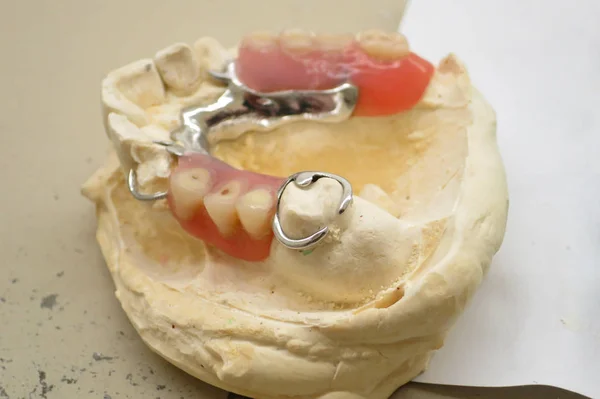 Dental Laboratory Denture Dental Impressions — Stock Photo, Image