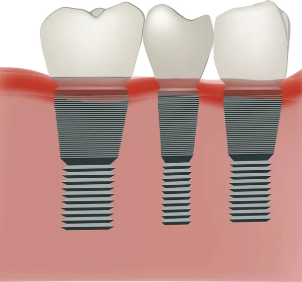 Dental prosthesis dental practice implant — Stock Vector