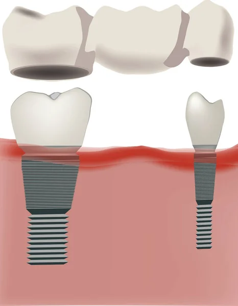 Fogprotézis fogászati implantátum — Stock Vector