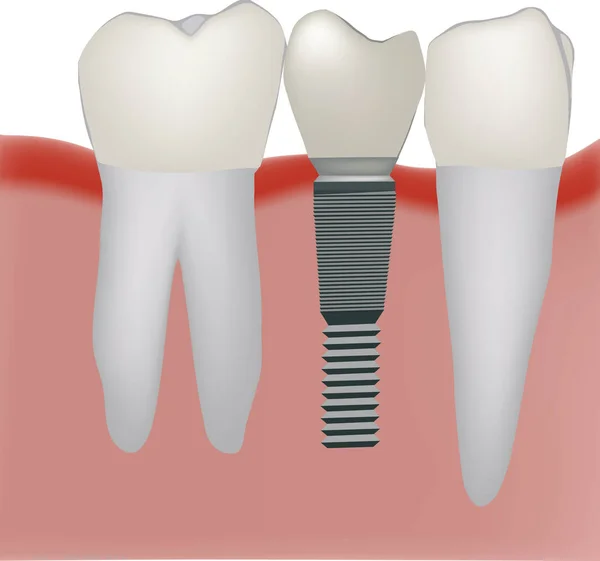 Fogprotézis Fogászati Implantátum — Stock Vector