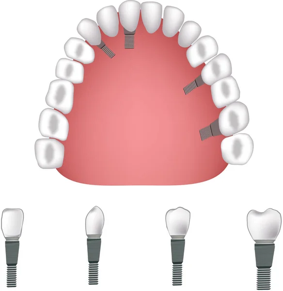 Descripción del aparato dental con sección de mandíbula — Vector de stock