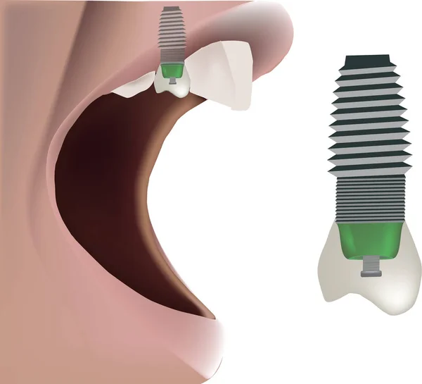 Letrero de prótesis dental clínica dental — Archivo Imágenes Vectoriales