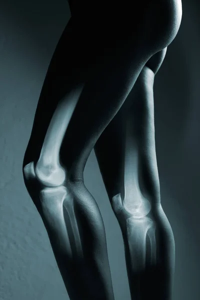 Articulación de rodilla humana y pierna en rayos X, sobre fondo gris — Foto de Stock