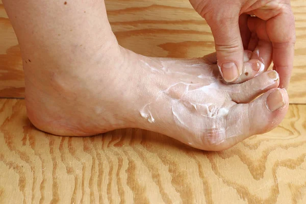 一个女人在她的脚上放了些奶油 脚霜对干皮肤和角膜在脚 奶油对运动员的脚 — 图库照片