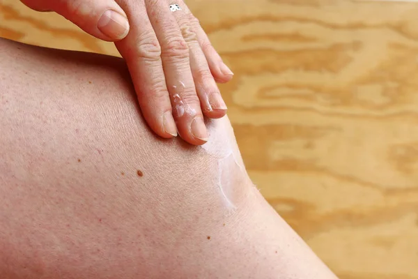 A woman rubs a pain ointment on her knee. Painful arthrosis of the knee