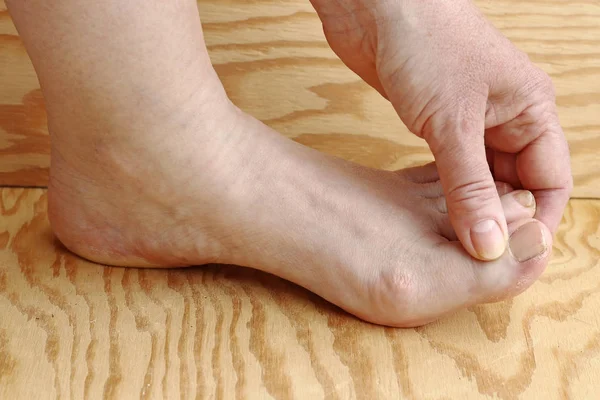 Woman Has Pain Her Feet Nail Fungus Feet — Stock Photo, Image