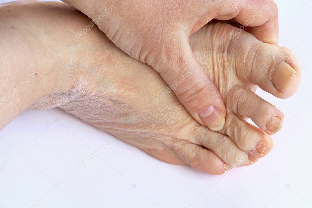 A woman has pain in her feet. Injury to the foot