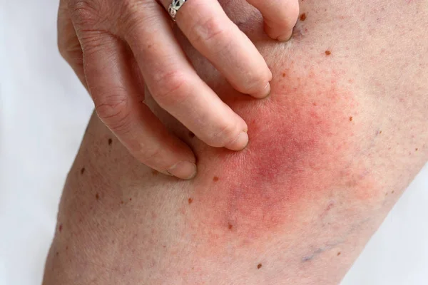 Αλλεργική Αντίδραση Μια Μέλισσα Τσίμπημα Στο Πόδι Μιας Γυναίκας Αλλεργικό — Φωτογραφία Αρχείου