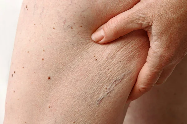 Spider veins and cellulite on a woman\'s leg. Pathological change in the leg