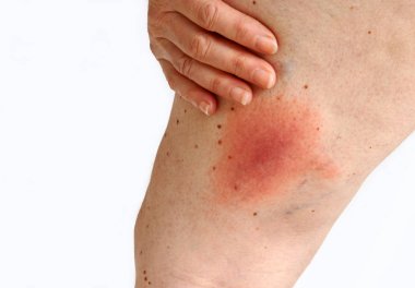 Bir kene tarafından iletilen bir kadının bacak floş Lyme borreliosis göçebe. Lyme hastalığı kene ısırması uylukta neden.