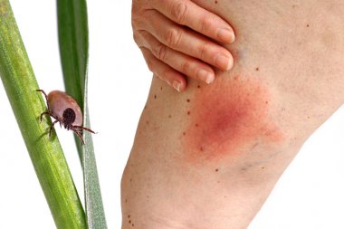 Bir kene tarafından iletilen bir kadının bacak floş Lyme borreliosis göçebe. Lyme hastalığı kene ısırması uylukta neden.