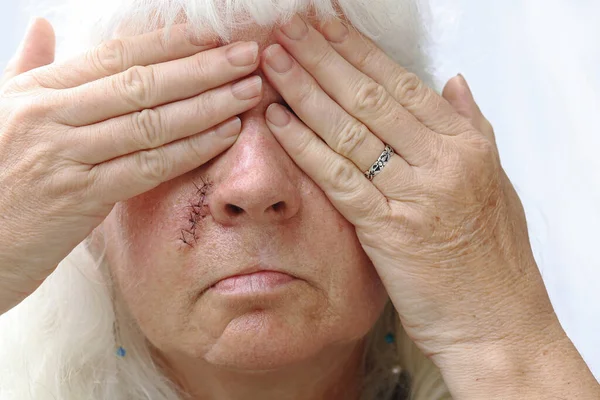 An older woman has a scar on her face and is ashamed of it. With scars in the face one would like to hide