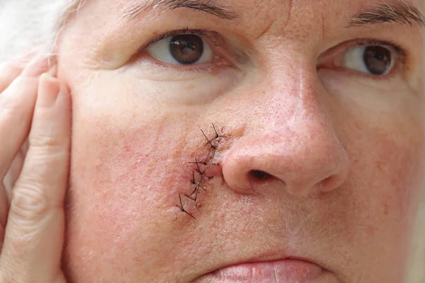 Older Woman Has Surgical Scar Her Face — Stock Photo, Image