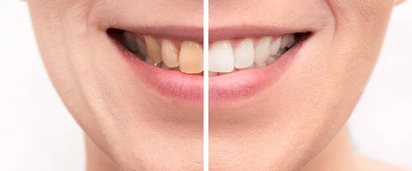 Blanqueamiento dental. Primer plano de la boca femenina . —  Fotos de Stock
