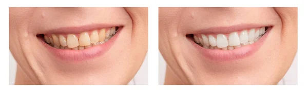 stock image Teeth whitening. Close up of female mouth.