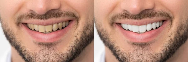 Dientes Antes Después Del Blanqueamiento Concepto Cuidado Dental —  Fotos de Stock