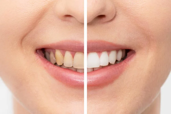 Zęby Przed Wybieleniu Koncepcja Opieki Stomatologicznej — Zdjęcie stockowe