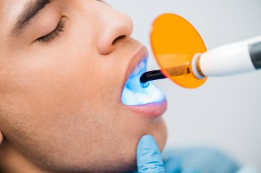 close up of handsome african american man during bleaching procedure  clipart