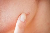 Ausgeschnittene Ansicht einer Frau, die mit dem Finger auf einen Maulwurf auf der Haut zeigt 