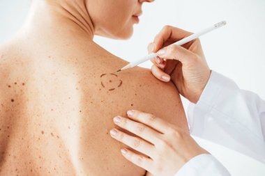 beyaz izole melanom ile çıplak kadının deri üzerinde işaretleri uygulayarak dermatolog kırpılmış görünümü 