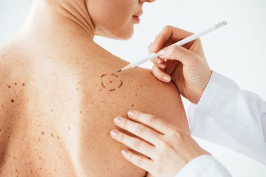 cropped view of dermatologist applying marks on skin of naked woman with melanoma isolated on white  clipart