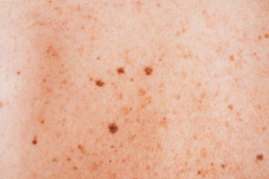 hastalıklı cilt melanomu olan hasta kadının yakın 