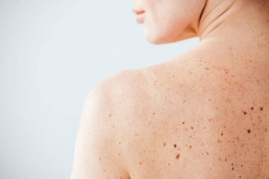 cropped view of diseased and naked woman with moles on skin on white  clipart