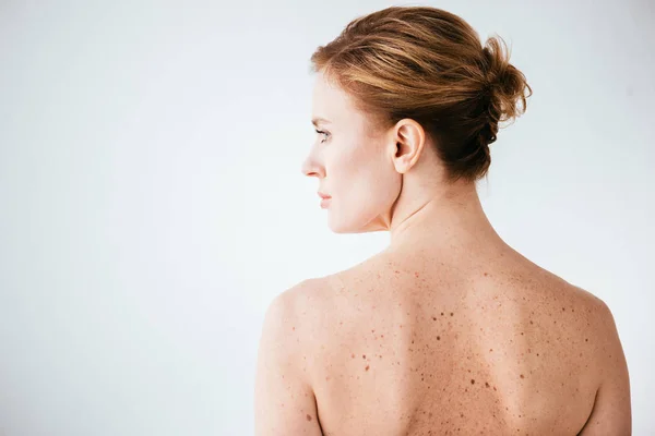 白に皮膚病を持つ魅力的で裸の女性 — ストック写真
