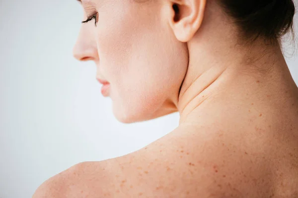 Beyaz Cilt Melanom Ile Çıplak Kadın Yakın — Stok fotoğraf