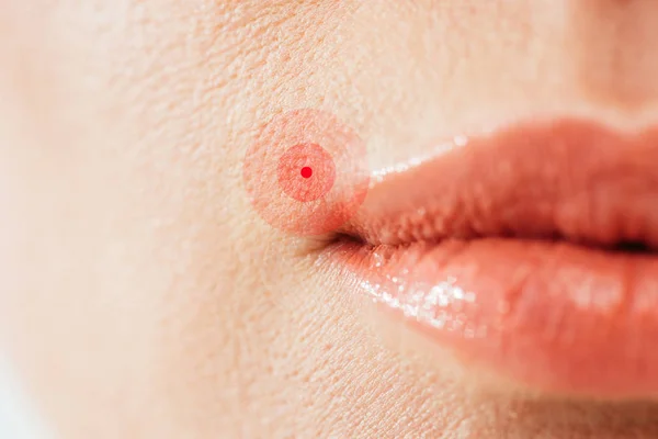 Vista Recortada Herpes Labios Mujer Enferma — Foto de Stock