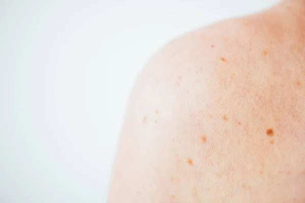 Cropped View Woman Melanoma Shoulder While — Stock Photo, Image