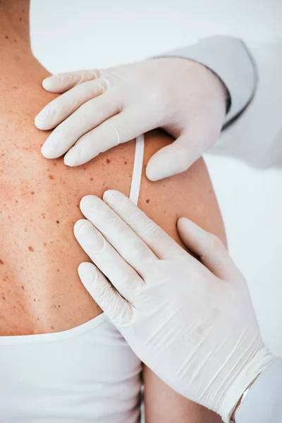 Oříznutý Pohled Dermatology Latexových Rukavicích Vyšetřující Ženu Melanom Zadní Izolované — Stock fotografie