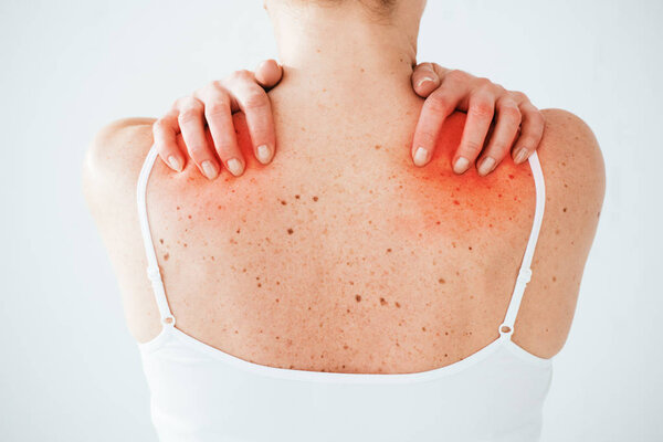 back view of sick woman with allergy scratching red skin on white 