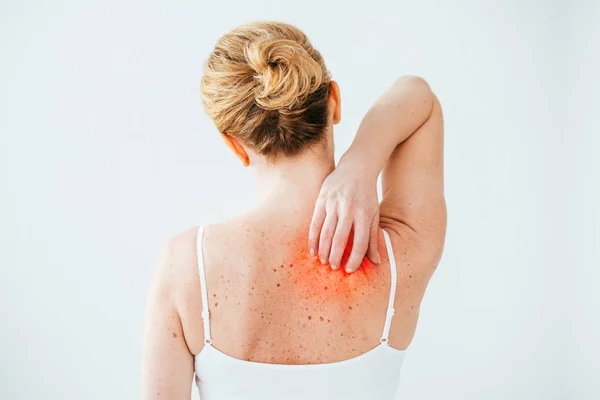 Vista Cortada Mulher Doente Com Alergia Arranhando Pele Vermelha Isolada — Fotografia de Stock