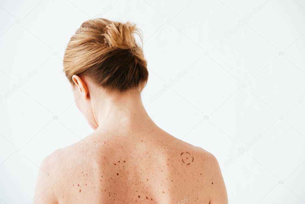 back view of woman with marks on skin isolated on white 