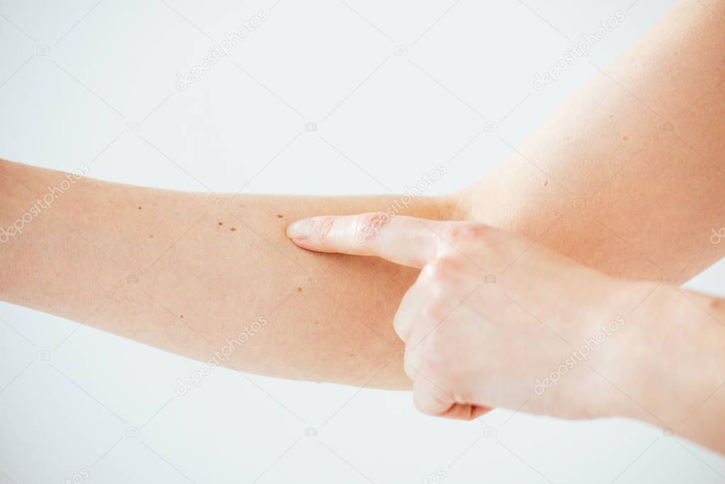 cropped view of woman pointing with finger at melanoma on white 