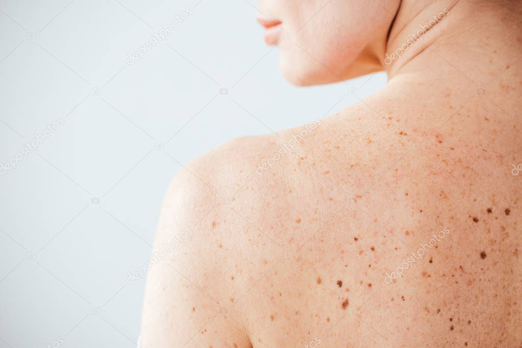 cropped view of diseased and naked woman with moles on skin on white 