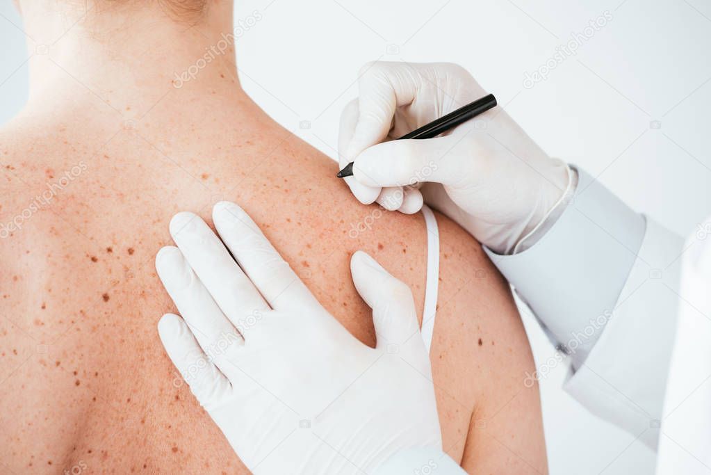 cropped view of dermatologist in white latex gloves holding marker pen near woman with melanoma isolated on white 
