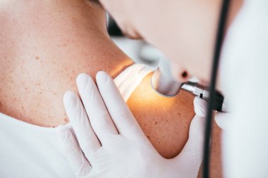 melanom lu kadını incelerken dermatoskop tutan dermatologun kırpılmış görünümü 