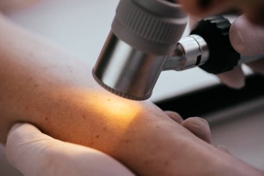 close up of dermatologist holding dermatoscope while examining woman with melanoma  clipart
