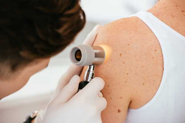cropped view of dermatologist in latex gloves holding dermatoscope while examining patient with skin disease  