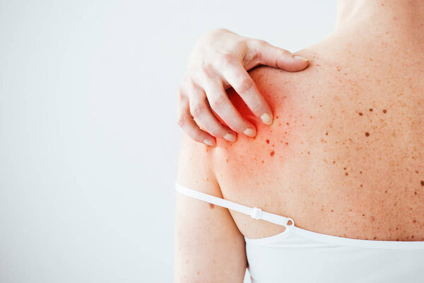 cropped view of sick woman with allergy scratching red skin on hand isolated on white 
